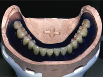 フランジテクニックを応用して制作中の下顎全部床義歯（総入れ歯）