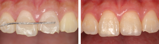歯の破折をコンポジットレジンで改善した症例