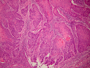 舌がんの病理部位の顕微鏡写真