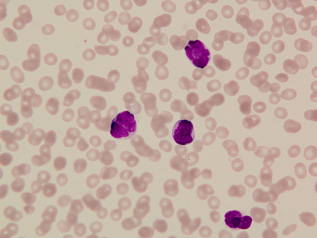 成人T細胞性白血病（ATL）の細胞