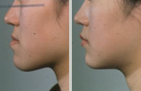 下あごの発育異常の手術（左：術前、右：術後）