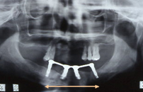 歯肉がんで切除した下あごを腰骨で再建（矢印の間）