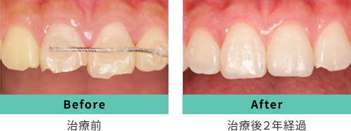 治療前・治療後2年経過時のBefore After写真