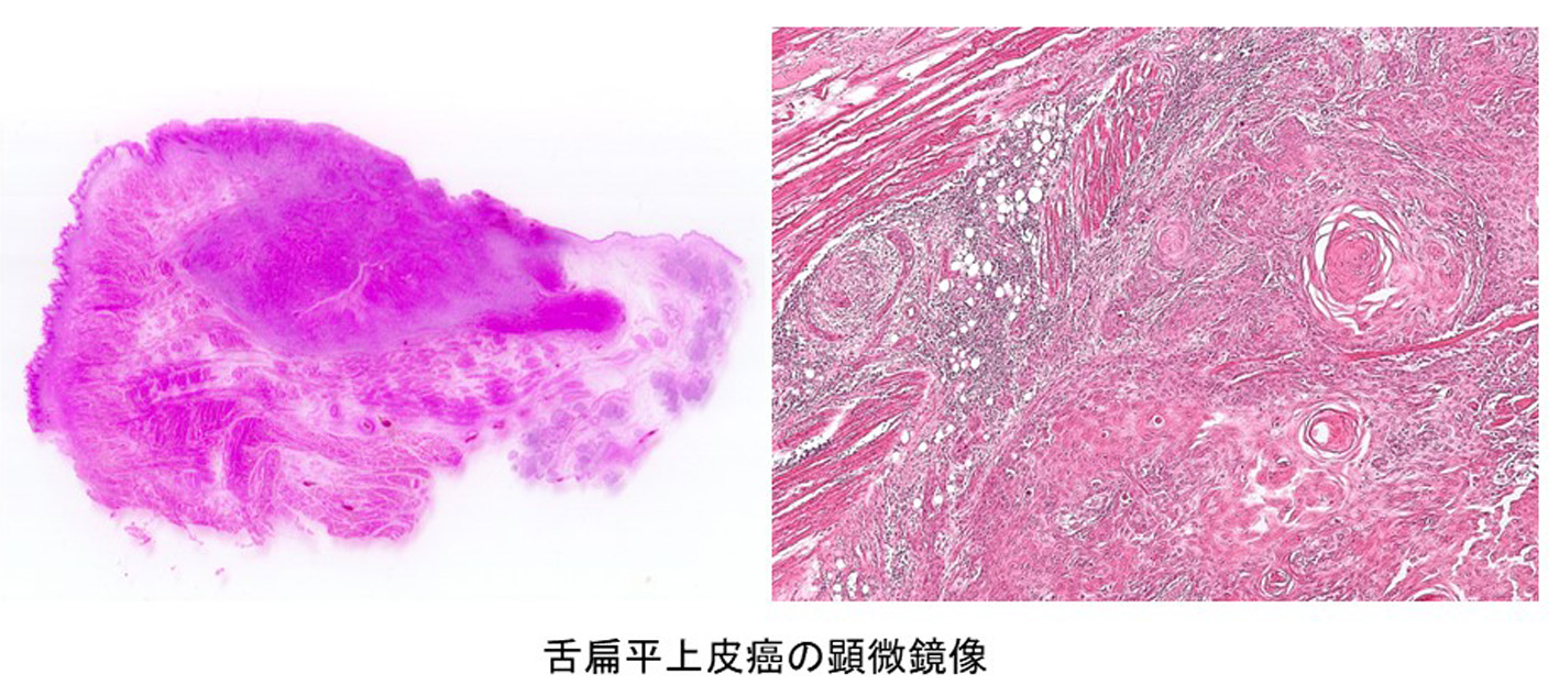 舌扁平上皮癌の顕微鏡像