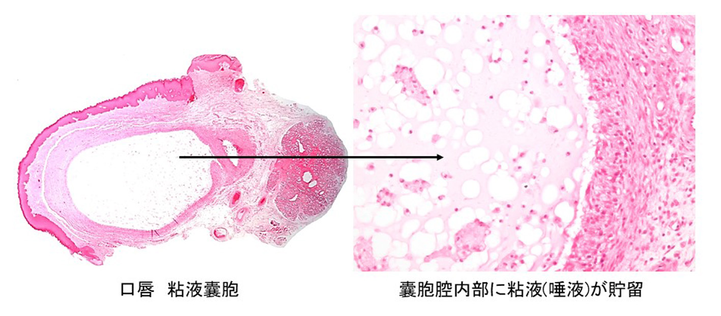 口唇 粘液嚢胞と、嚢胞腔内部に粘液（唾液）が貯留している様子