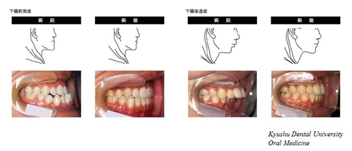 顎変形症手術の術前と術後の比較画像。イラストと写真それぞれで比較されている。