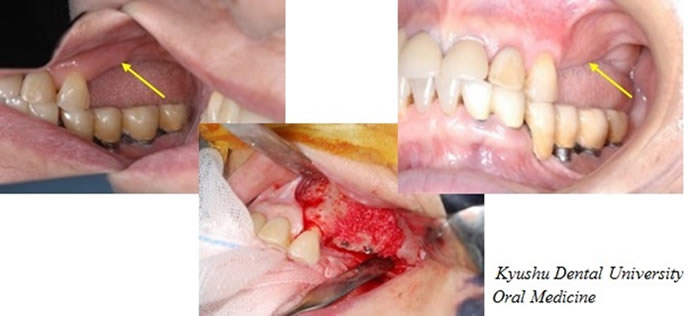 骨造成手術の写真。手術の様子が3つの写真で表示されている。