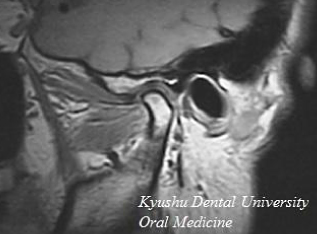 顎関節のMRI画像