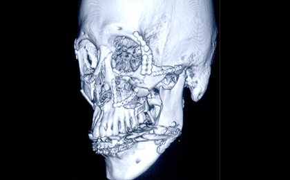 口腔顎顔面外科の3DCT写真