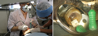 歯科用マイクロスコープ下での治療（左：治療光景、右：歯内治療の様子）
